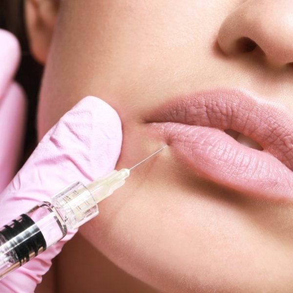 Lip Fillers For The Wedding - pros and cons