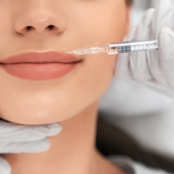 Lip Fillers For The Wedding