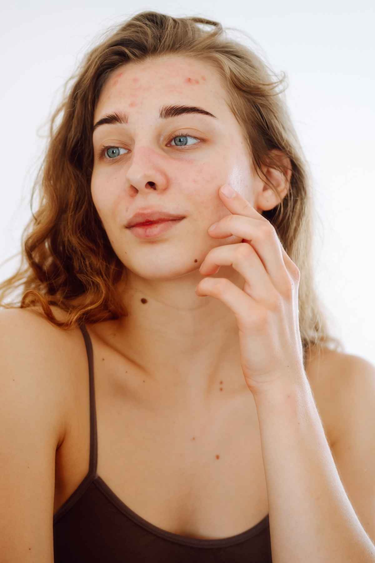 How Does Stress Affect Your Skin and What Can You Do About It?